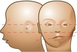 Microsomia hemifacial i logopèdia