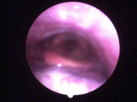 ¿Tendré voz después de una operación de cuerdas?